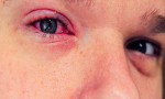 Her kırmızı göz, korona virüs göstergesi değildir