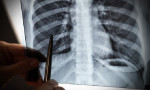 Uzman isimden korkutan akciğer kanseri açıklaması!
