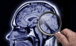 Demans ve Alzheimer belirtileri neler?