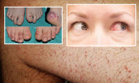 Korona virüs nedeniyle cildinizde meydana gelebilecek değişiklikler