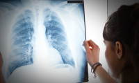 Akciğer kanserinin 8 önemli sinyali!