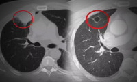 Dünya tıp literatüründe bir ilk: Kovid, akciğer kanserini taklit etti!