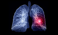 Uzmanı yanıtladı: Salgında akciğerleri nasıl koruyabiliriz?