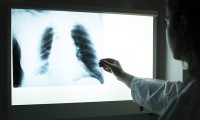 Omikron akciğerlere daha az zarar veriyor: 6 çalışmadan ortak sonuç