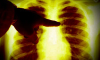 O kişilerde risk 30 kat daha fazla: İşte akciğer kanserinin belirtileri