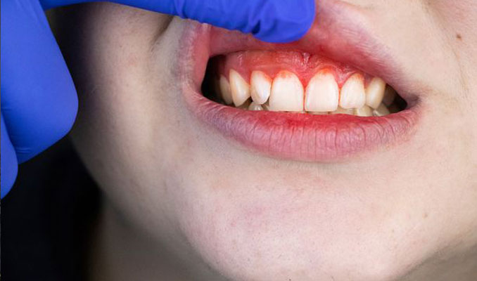 Diş eti hastalığı olan pozitif vakaların ölüm oranı korkutuyor!