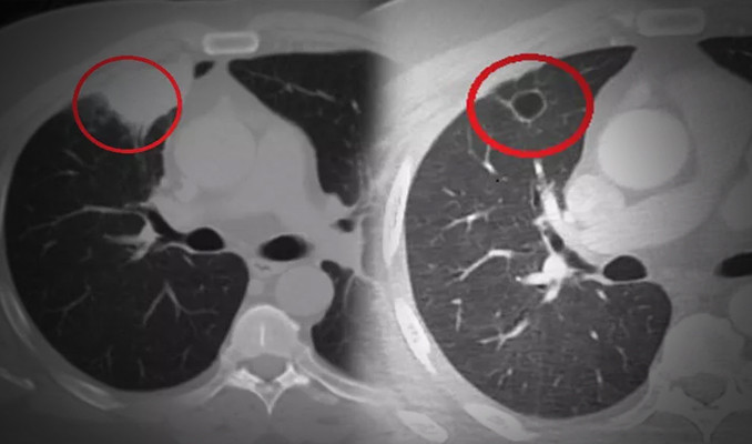 Dünya tıp literatüründe bir ilk: Kovid, akciğer kanserini taklit etti!